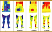 ラジオ波によって体温が上がっている様子サーモグラフィー