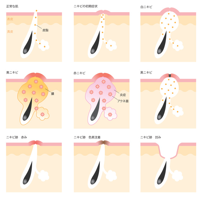 ニキビの原因