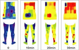 ラジオ波で体温が上がっている様子のサーモグラフィー