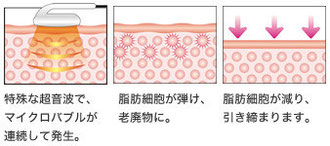 特殊な超音波で、マイクロバブルが連続して発生。脂肪細胞が弾け、老廃物に。脂肪細胞が減り、引き締まります。
